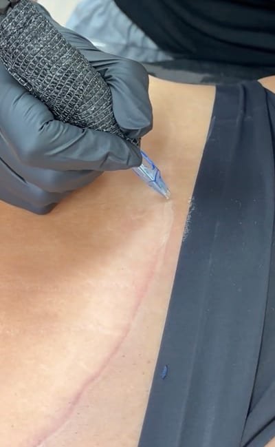 Custom-matched pigment being implanted along a surgical scar during a scar camouflage session